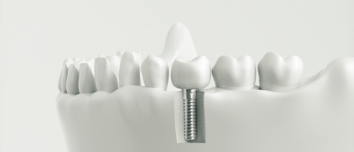 Zahnimplantat mit Knochenstruktur